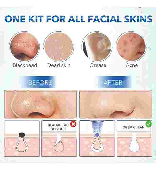 DERMA SUCTION 8