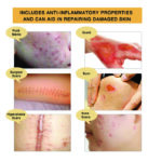 SCAR AND ACNE MARK REMOVAL