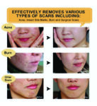 SCAR AND ACNE MARK REMOVAL