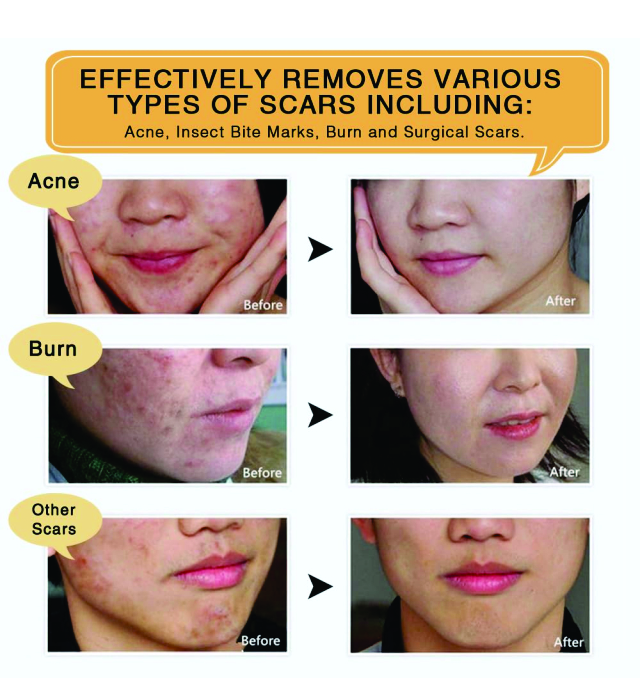 SCAR AND ACNE MARK REMOVAL 4