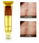 SCAR AND ACNE MARK REMOVAL