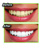 MIRACLE TEETH WHITENER (Natural Charcoal Based Teeth Whitening)